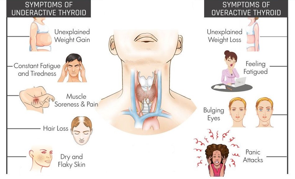 Enfermedad relacionada con la tiroides