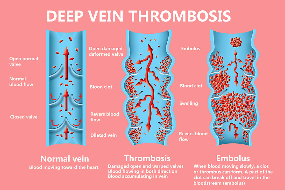 La trombosis es la formación de un coágulo de sangre en un vaso sanguíneo. 