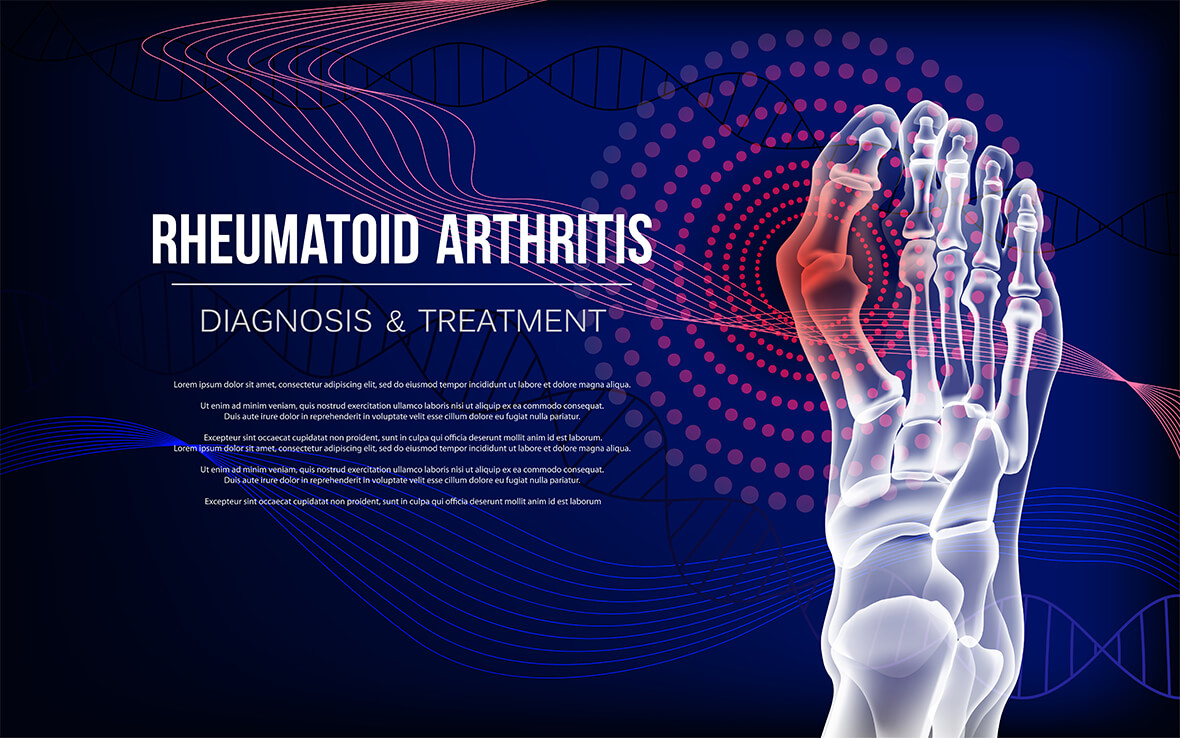 La artritis reumatoide (AR) es una enfermedad autoinmune crónica que afecta principalmente a las articulaciones